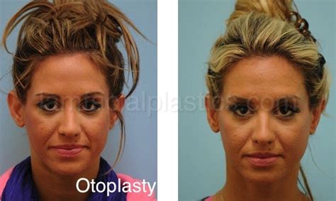 Otoplasty And Ear Pinning Surgery Dallas Tx Dr Lam