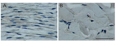 Immunohistochemical Staining Of HtrA1 Protein In Keloid A And Normal