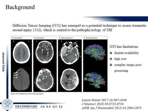 【journal Club】神经丝轻链作为创伤性脑损伤的生物标志物 搜狐大视野 搜狐新闻