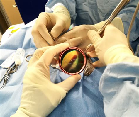 Vitrectomy Surgery In Iran Medpersia Medical Tourism