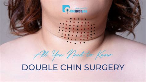 Double Chin Surgery - Know Everything You Will Ever Need