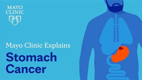 Mayo Clinic explains stomach cancer - Medical Follower