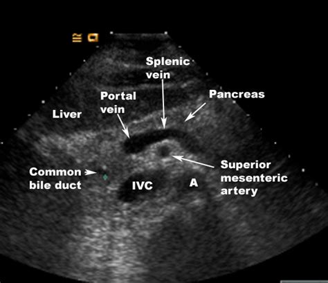 Splenic Vein Ultrasound