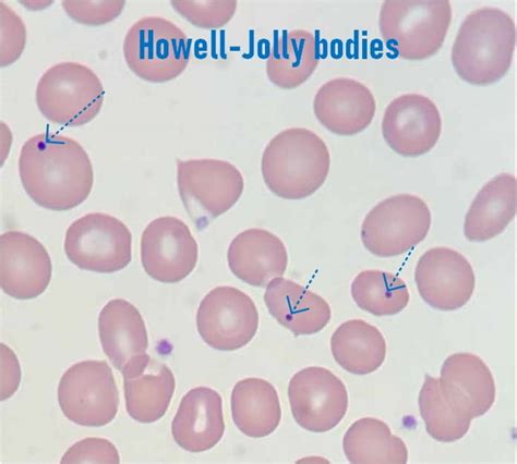 Howell Jolly Bodies: Definition, Causes, Detection and Clinical ...