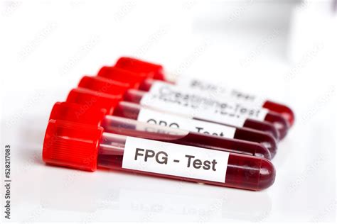 Fpg Test From Blood Blood Samples To Be Analyzed In The Laboratory