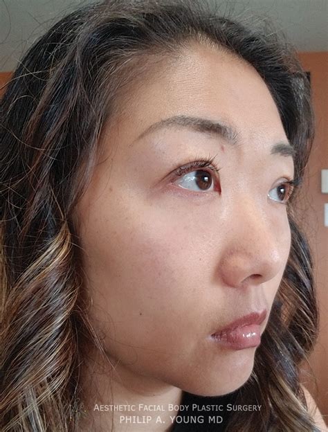 Asian Plastic Surgery Before And After Photos Seattle Bellevue