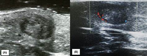 Gray Scale A And Color Doppler B Sonograms Show A Circumscribed