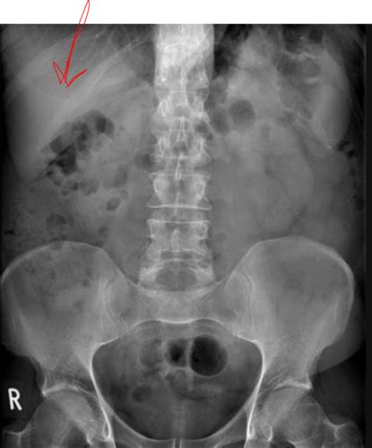 Class 6 Abdominal Radiographs X Rays Flashcards Quizlet