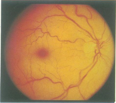 Central Retinal Artery Occlusion Vs Normal