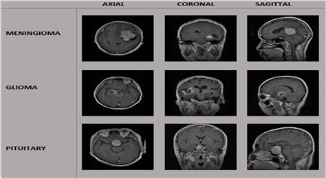 Three Different Tumors Meningioma Glioma And Pituitary Tumor In