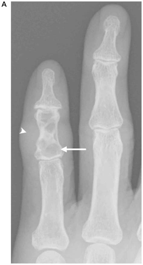 Coexistence Of Giant Cell Tumor Of Tendon Sheath And Enchondroma In The