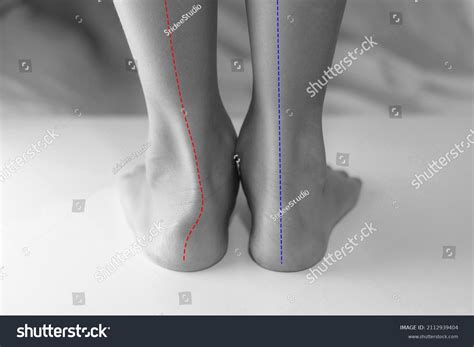 43 Ankle Inward Images Stock Photos 3d Objects And Vectors Shutterstock