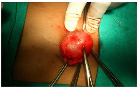 Figure From Unusual Presentation Of A Congenital Bronchogenic Cyst In