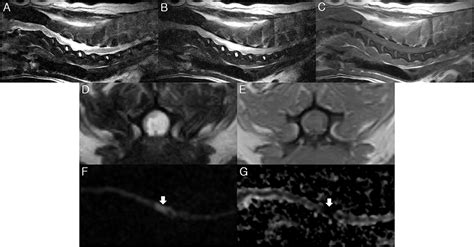 Sequence Specific Mr Imaging Findings That Are Useful In Dating Ischemic Stroke Telegraph