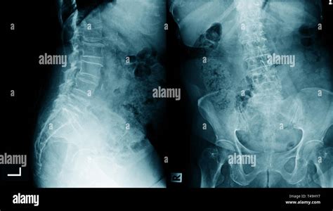 Lumbar Spondylosis X Ray Image Ap And Lateral View Stock Photo Alamy