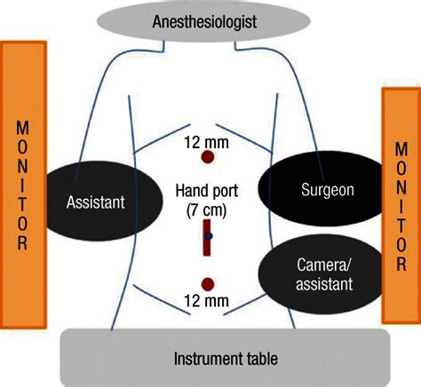 Operating Room Setup For Hand Assisted Laparoscopic Right Hemicolectomy