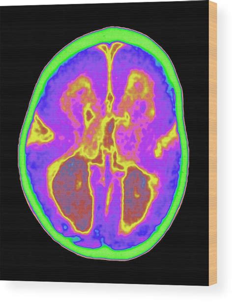 Lissencephaly Mri