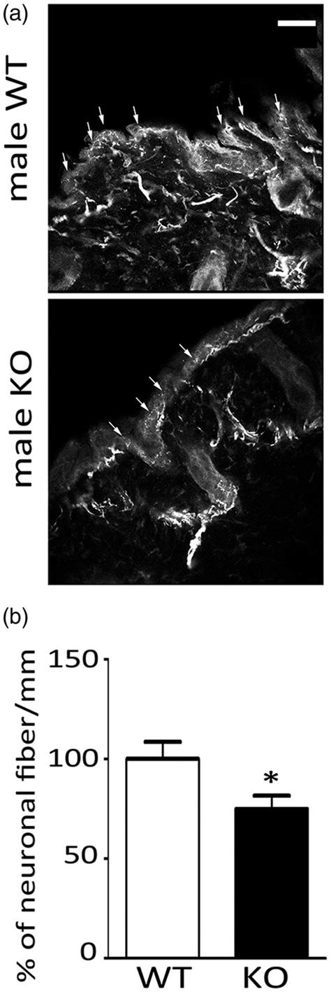 Increased Expression Of Trpv1 In Peripheral Terminals Mediates Thermal