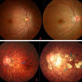 A Normal Fundus A Female Year Old Right Eye D B