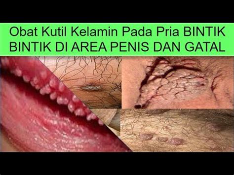 Ciri Kutil Kelamin Menular Tumbuh Bintik Daging Di Kemaluan Dan Gatal