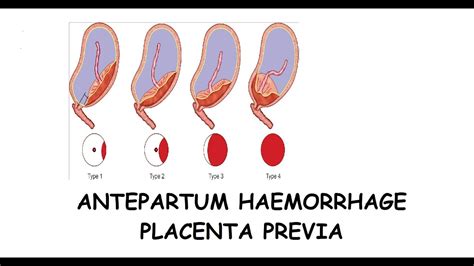 What Are The Placenta Previa Types Causes And Its Management Antepartum Haemorrhage Youtube