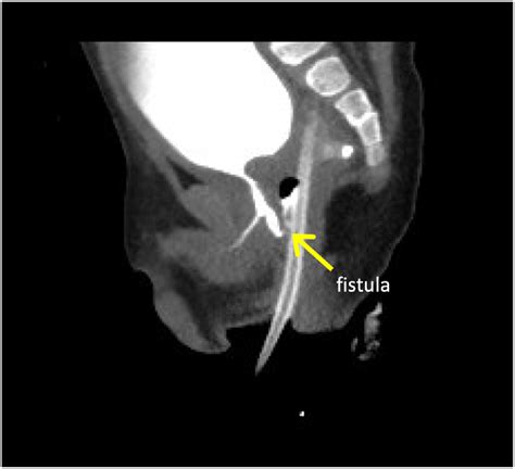 Robotic Assisted Laparoscopic Repair Of A Congenital Rectourethral