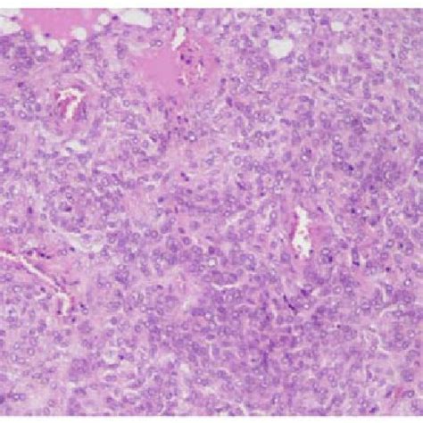 Short Spindle Shaped Tumor Cells With Blood Vessels In The Interstitium