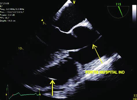 Mid Esophageal Aortic Valve Long Axis View Demonstrating An Artifact