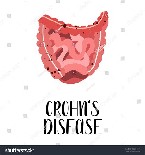 Crohns Disease Intestines Diseases Gastroenterology Vector Stock Vector