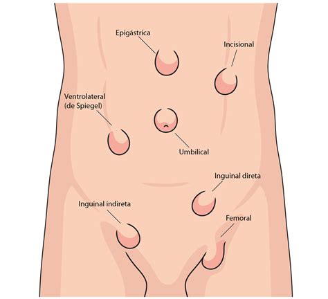 Resumo das hérnias da parede abdominal