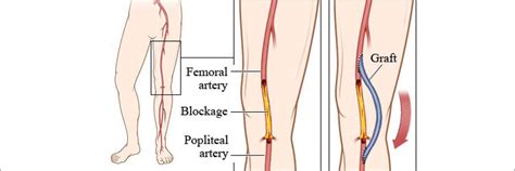 Best Doctor Gangrene Treatment in Borivali | Dr Simit Vora