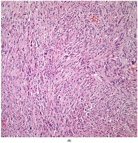 Pulmonary Carcinomas With Spindle And Or Giant Cell Features