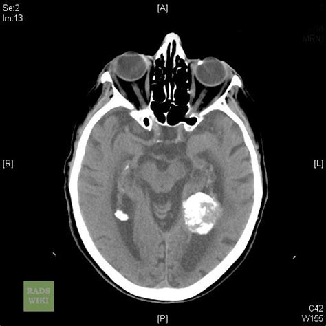 Intraventricular Meningioma Image