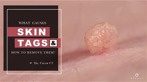 Skin Tags Seborrheic Keratosis Warts What S The Difference Dr