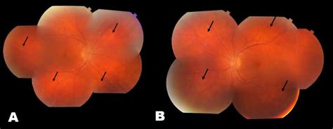 Moran Core Birdshot Chorioretinopathy