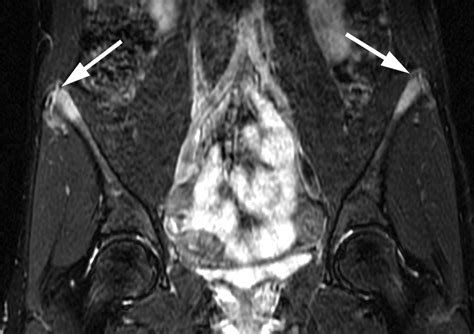 Avulsion Fracture Hip Iliac Crest