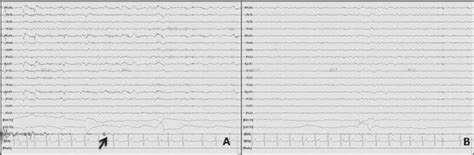 Status Cataplecticus As Initial Presentation Of Late Onset Narcolepsy Journal Of Clinical