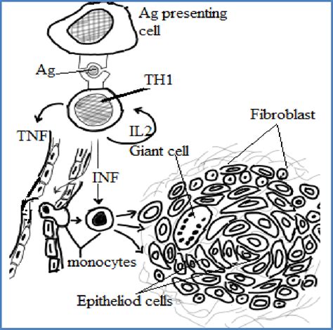 Cellular Events In Granuloma Easy Example Of Chronic Granulomatous Download Scientific Diagram