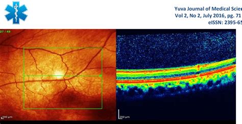 Figure 3 from TOXOPLASMA RETINOCHOROIDITIS WITH INVOLVEMENT OF 2ND AND 3RD CRANIAL NERVE: A RARE ...