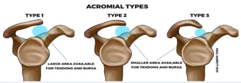 Diagnosis And Treatment Of Subacromial Impingement Syndrome Flashcards Quizlet