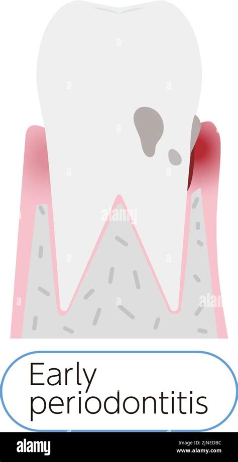 Illustration By Stage Of Periodontal Disease Early Periodontitis Stock