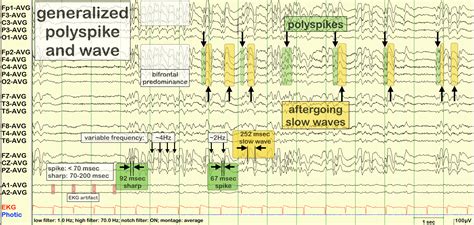 Poly Spike And Wave