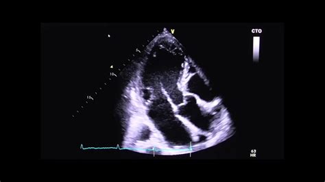 Dilated Cardiomyopathy Echo