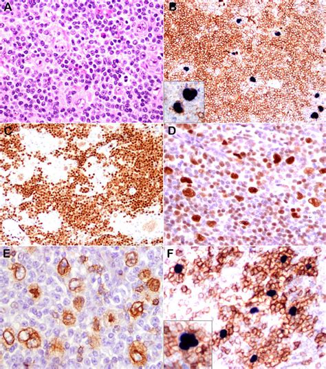 Representative Examples Of Ebv Positive Nlphl Cases 3 And 12 A Lp