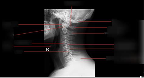 Lateral Projection Of C Spine Diagram Quizlet