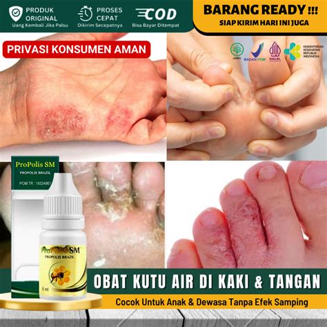 Jual Obat Tradisional Gatal Lecet Di Sela Sela Jari Tangan Kaki