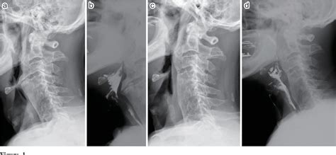 Figure 1 From Surgical Treatment For Cervical Diffuse Idiopathic Skeletal Hyperostosis As A