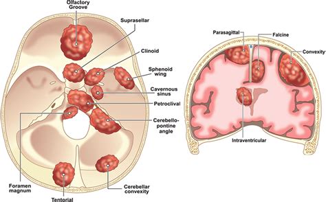 Illustrations Showing Locations Of Intracranial Meningiomas Left