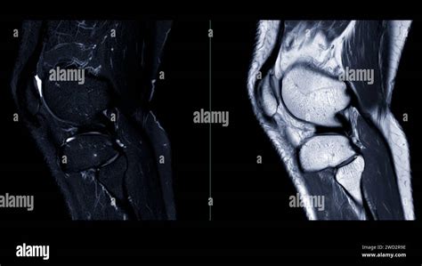 Magnetic Resonance Imaging Or MRI Of Knee Joint This Diagnostic