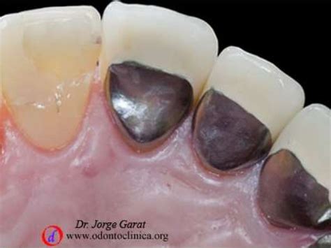 Preparación dentaria para coronas metal porcelana